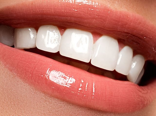 lente_de_contato_dental