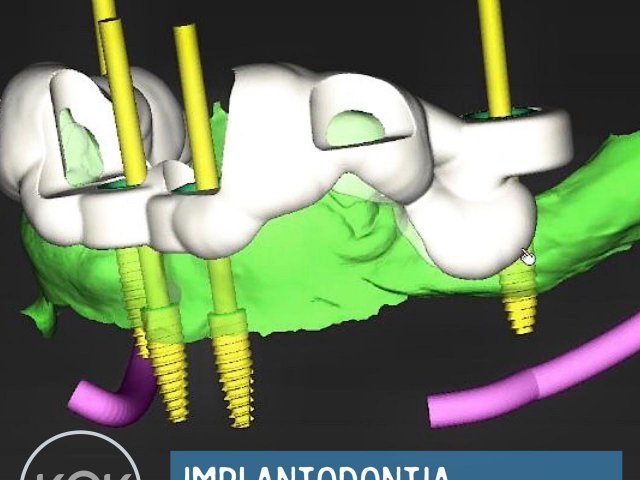 Implantodontia