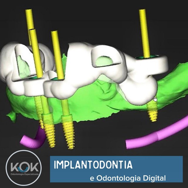 Implantodontia